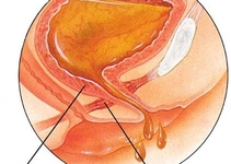 Akut Sistit Belirtileri ve Tedavisi